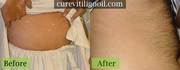 Pictures Of Vitiligo