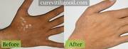 Vitiligo Treatment