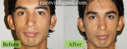 cure vitiligo oil
