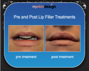 Fillers in Cheshire