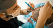 Synthetic Hair Transplant: Revolutionizing Hair Restoration